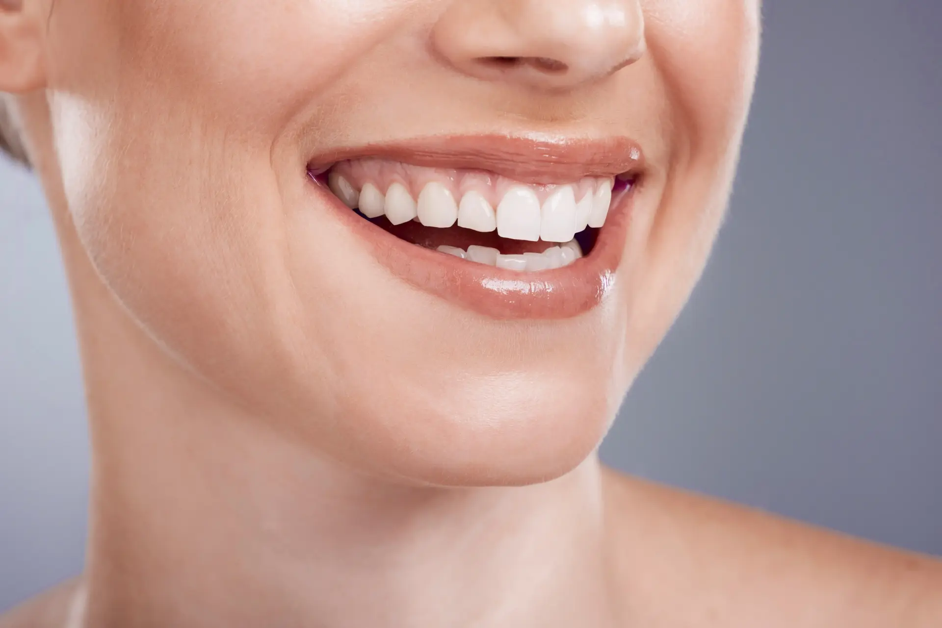 Fertig befestigte Veneers an den Frontzähnen
